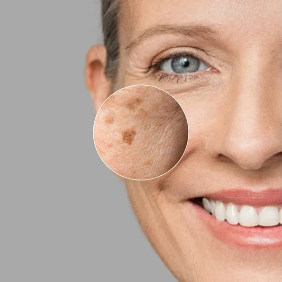 Janssen Dark Spot Perfector | Serumas pigmentinių dėmių pašalinimui 30 ml