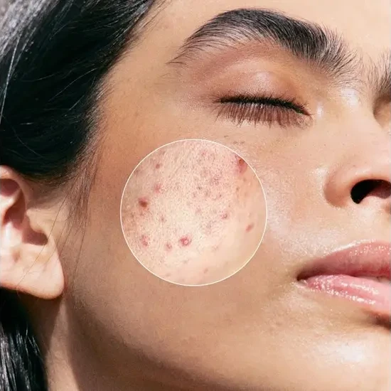 Janssen Cosmetics Purifying BHA Serum | Serumas su salicilo rūgštimi probleminei odai, 30 ml