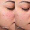 Medik8 Press & Clear Refill | Pildomas BHA tonikas probleminiaiems odos tipams 150 ml